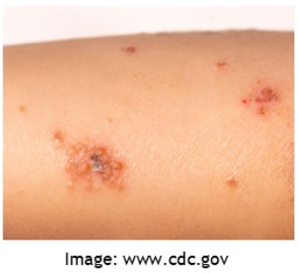 impetigo