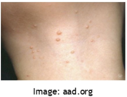 Molluscum contagiosum