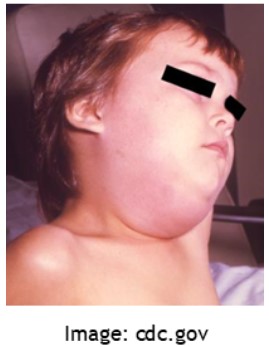 child with mumps
