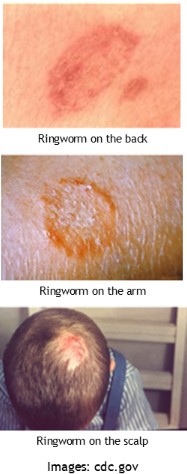 ringworm