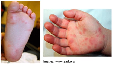 hfm on foot and hand