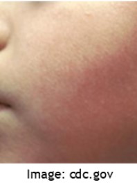 someone's cheek with 5th disease