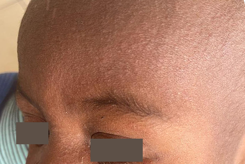young boy with measles skin rash on forehead