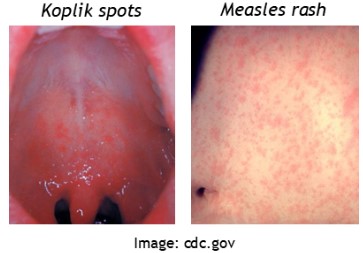 koplik spots and measles rash