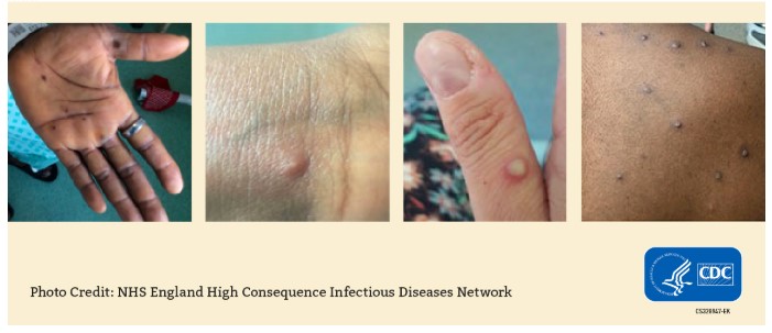 mpox rash photos