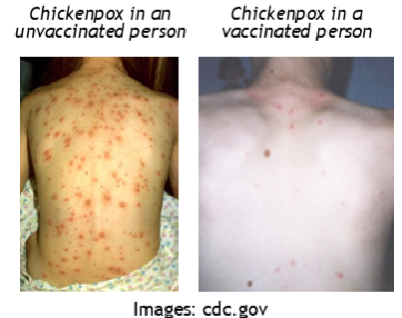 bare backs with chicken pox