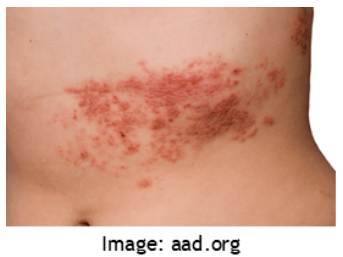 stomach with chickenpox outbreak