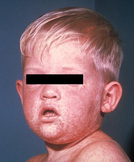 young boy with measles skin rash