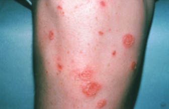 impetigo rash on leg