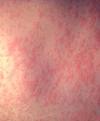 measles rash