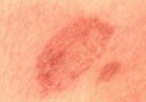 ringworm rash