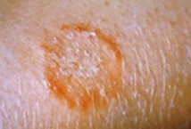 ringworm rash