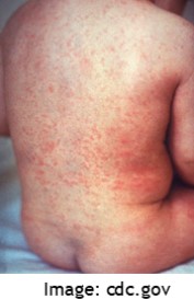 rubella rash