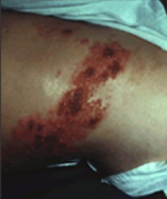 shingles rash