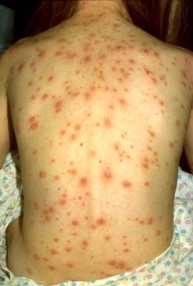 bare back with chickenpox