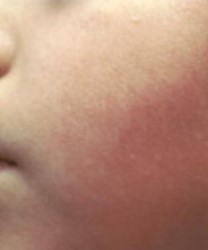 cheek with signs of fifth disease
