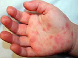 hand with hfm rash