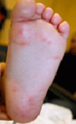 foot with hfm rash