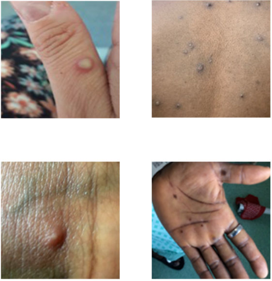 monkeypox signs